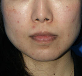 40代女性のメディカル美肌セレクト Before 症例写真