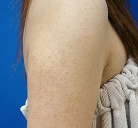 20代女性の毛孔性苔癬・角化症 Before 症例写真