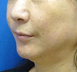 50代女性のサーマクール After 症例写真