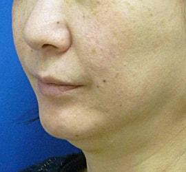 50代女性のサーマクール Before 症例写真