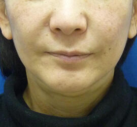 50代女性の Before 症例写真