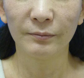 50代女性の After 症例写真