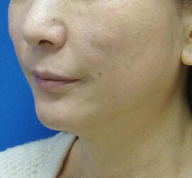 50代女性の After 症例写真