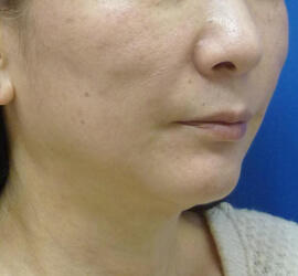 50代女性のシワ・たるみ After 症例写真