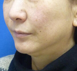 50代女性の Before 症例写真
