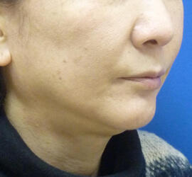 50代女性のシワ・たるみ Before 症例写真