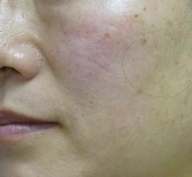 40代女性のシワ・たるみ After 症例写真