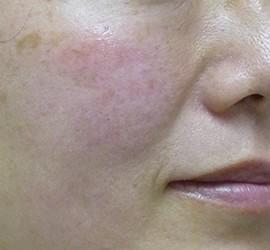 40代女性のヒアルロン酸注射  After 症例写真