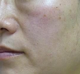 40代女性のシワ・たるみ Before 症例写真