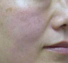 40代女性のヒアルロン酸注射  Before 症例写真