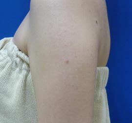 20代女性の毛孔性苔癬・角化症 After 症例写真