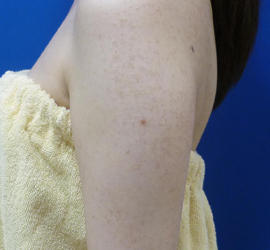 20代女性の毛孔性苔癬・角化症 Before 症例写真