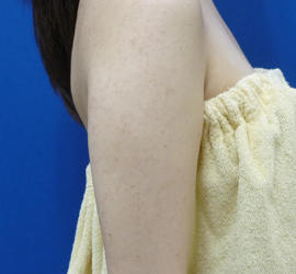 20代女性のFotonaフラクショナルレーザー（毛孔性苔癬） Before 症例写真