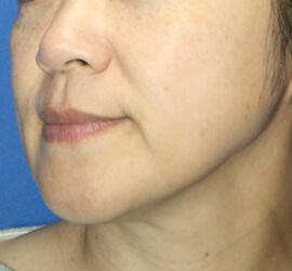 40代女性のメディカル美肌セレクト After 症例写真