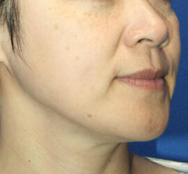 40代女性のメディカル美肌セレクト After 症例写真