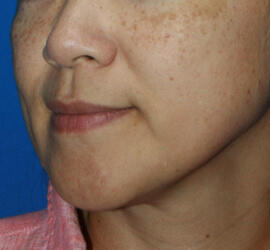 40代女性のメディカル美肌セレクト Before 症例写真