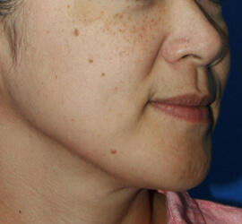 40代女性のメディカル美肌セレクト Before 症例写真