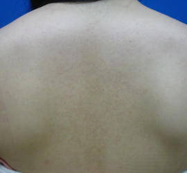 20代女性の毛孔性苔癬・角化症 After 症例写真