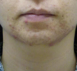 30代女性の小林式ニキビ治療法 After 症例写真