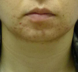 30代女性の小林式ニキビ治療法 After 症例写真