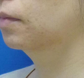 30代女性の小林式ニキビ治療法 After 症例写真