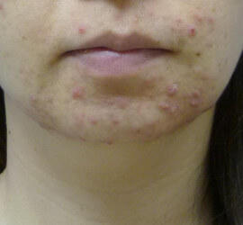 30代女性の小林式ニキビ治療法 Before 症例写真