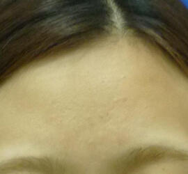 20代女性の小林式ニキビ治療法 After 症例写真