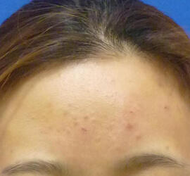 20代女性の小林式ニキビ治療法 Before 症例写真