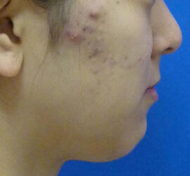 20代女性の小林式ニキビ治療法 Before 症例写真