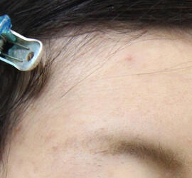 20代女性の小林式ニキビ治療法 After 症例写真