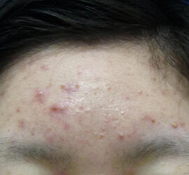20代女性の小林式ニキビ治療法 Before 症例写真