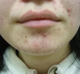 20代女性の小林式ニキビ治療法 Before 症例写真