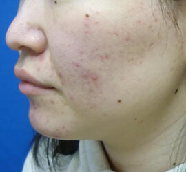 20代女性の小林式ニキビ治療法 Before 症例写真
