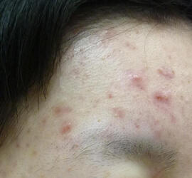 20代女性の小林式ニキビ治療法 Before 症例写真