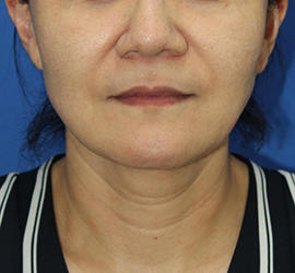 50代女性の顔の脂肪吸引  After 症例写真