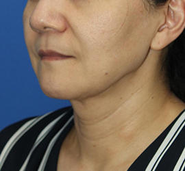 50代女性の顔の脂肪吸引  After 症例写真