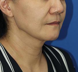 50代女性のシワ・たるみ After 症例写真