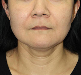 50代女性の顔の脂肪吸引  Before 症例写真