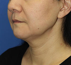 50代女性の顔の脂肪吸引  Before 症例写真