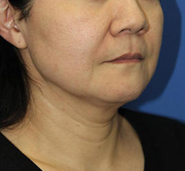 50代女性のシワ・たるみ Before 症例写真