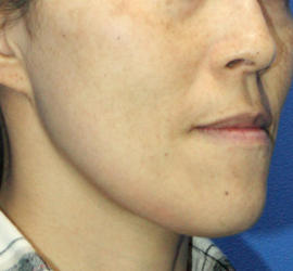 40代女性のフォトRF（SR） After 症例写真