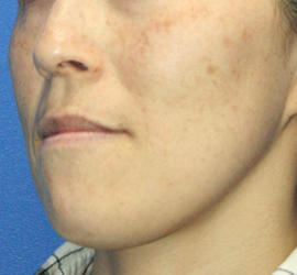 40代女性のフォトRF（SR） After 症例写真