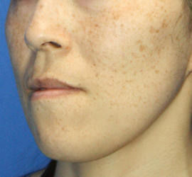 40代女性のフォトRF（SR） Before 症例写真