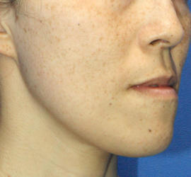 40代女性のフォトRF（SR） Before 症例写真