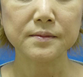 40代女性のシワ・たるみ After 症例写真