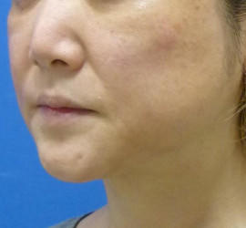 40代女性のヒアルロン酸注射  After 症例写真