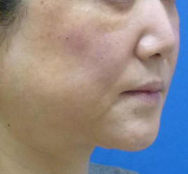 40代女性のヒアルロン酸注射  After 症例写真