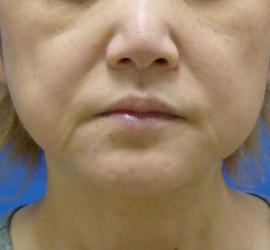 40代女性のシワ・たるみ Before 症例写真