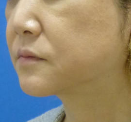 40代女性のヒアルロン酸注射  Before 症例写真