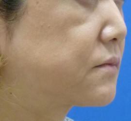 40代女性のヒアルロン酸注射  Before 症例写真